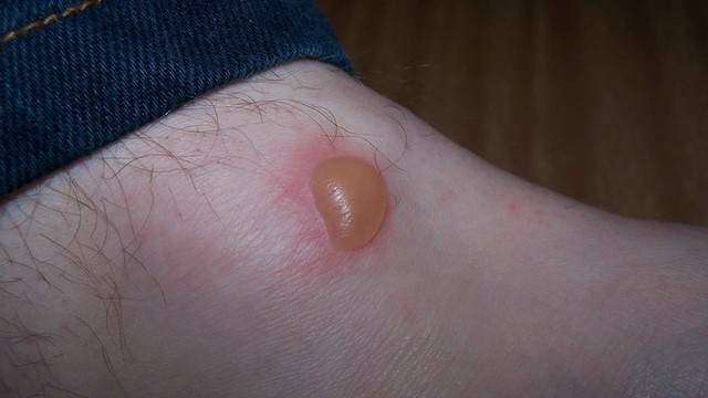 bai-viet/nhan-biet-vet-con-trung-can-bi-bong-nuoc-va-cach-xu-ly-cu-the-58238.html