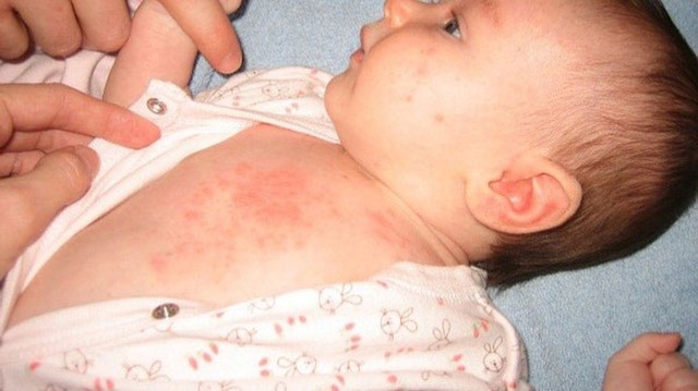 bai-viet/nhan-dien-hinh-anh-rom-say-o-tre-so-sinh-dau-hieu-va-giai-phap-dieu-tri.html