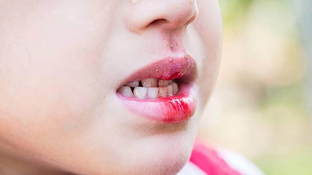 bai-viet/nhiet-mieng-chay-mau-chan-rang-co-sao-khong-phong-ngua-bang-cach-nao.html