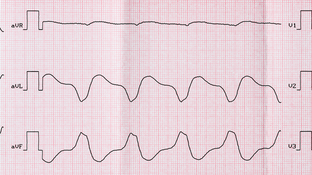 benh/nhip-nhanh-that-240.html