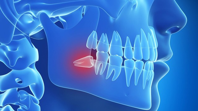 bai-viet/nho-rang-khon-co-nguy-hiem-khong-phong-ngua-bien-chung-sau-nho-rang-khon.html