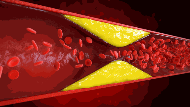 bai-viet/nhoi-mau-dong-mach-mac-treo-la-gi-nhung-thong-tin-can-biet.html