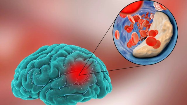 bai-viet/nhoi-mau-nao-tham-lang-la-gi-nguyen-nhan-va-trieu-chung-cua-benh.html