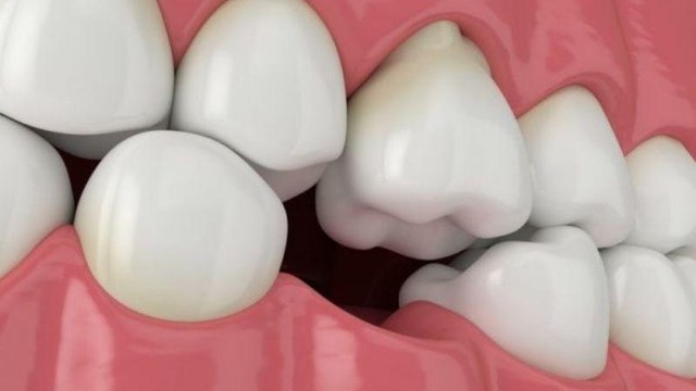 bai-viet/nhung-anh-huong-ve-suc-khoe-cua-tieu-xuong-ham-72961.html