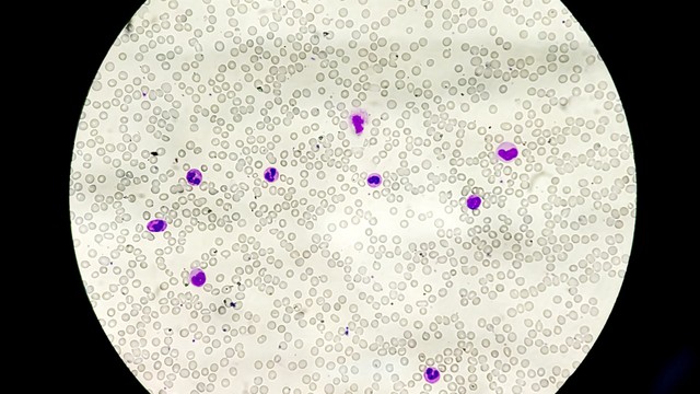 bai-viet/co-che-giam-tieu-cau-trong-sot-xuat-huyet-la-gi-hau-qua-cua-giam-tieu-cau-khi-bi-sot-xuat-huyet.html