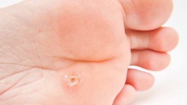 bai-viet/nhung-dau-hieu-va-trieu-chung-mun-coc-long-ban-chan.html