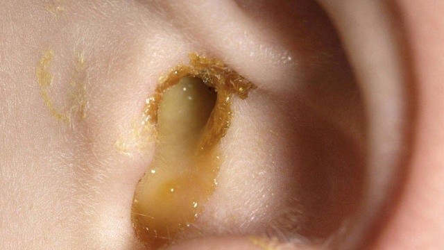 bai-viet/nhung-dieu-can-biet-ve-benh-ly-tai-chay-mu-57195.html