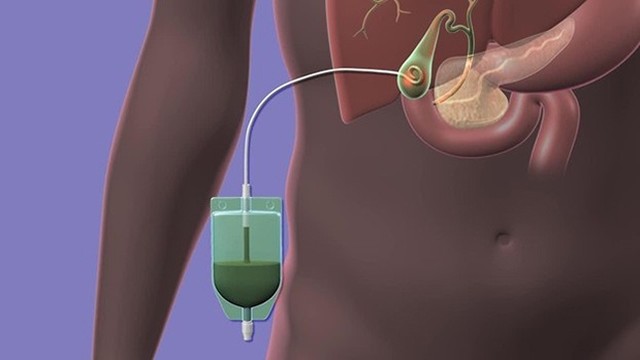 bai-viet/nhung-dieu-can-biet-ve-dan-luu-kehr-sau-phau-thuat-lay-soi-duong-mat.html