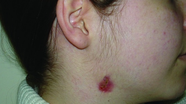 bai-viet/nhung-dieu-can-biet-ve-nang-va-ro-bam-sinh-vung-co.html