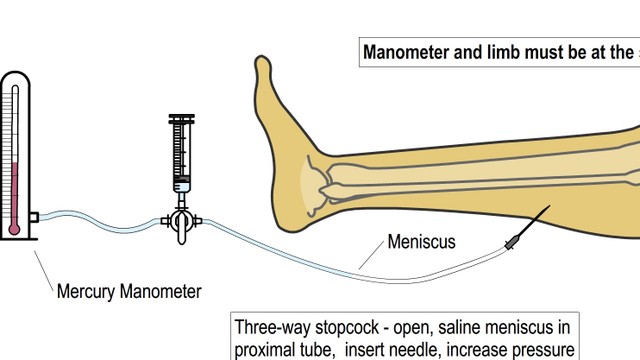 bai-viet/nhung-dieu-can-biet-ve-phuong-phap-whitesides-va-hoi-chung-chen-ep-khoang.html