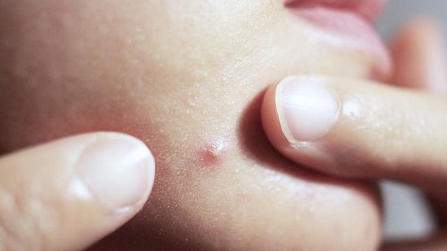 bai-viet/nhung-dieu-ve-mun-bi-chai-cung-duoi-da-ai-cung-nen-biet-67012.html