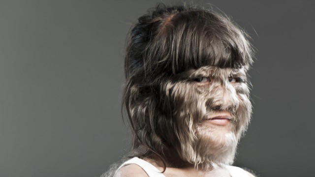 bai-viet/nhung-hoi-chung-benh-hiem-gap-o-con-nguoi-47641.html