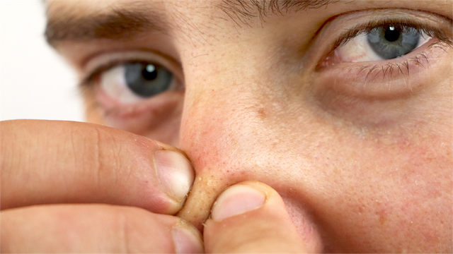 bai-viet/mot-cach-tri-mun-dau-den-tu-thien-nhien-tai-nha-ban-nen-biet.html