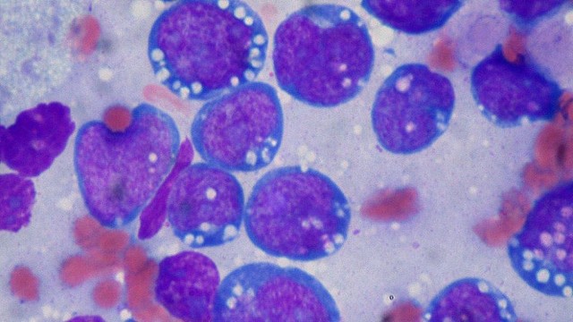 bai-viet/nhung-thong-tin-can-biet-ve-benh-u-lympho-burkitt.html