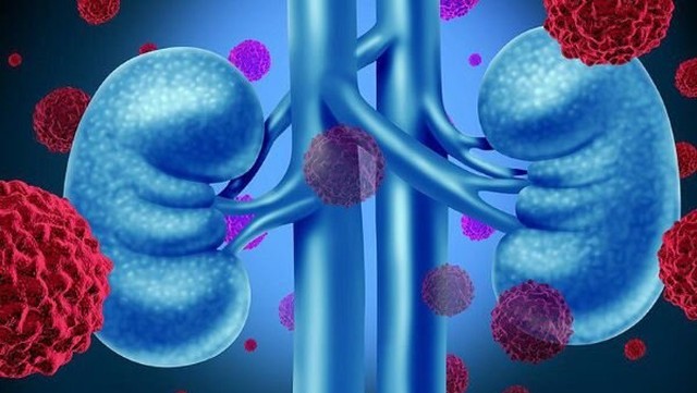 bai-viet/nhung-tien-bo-trong-dieu-tri-ung-thu-than-hien-nay.html