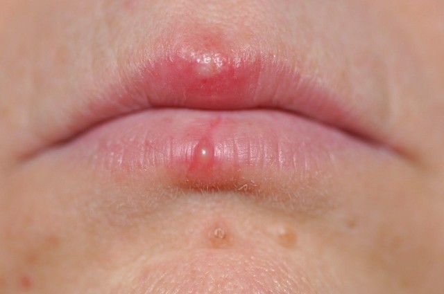 bai-viet/nhung-trieu-chung-benh-zona-giup-ban-phat-hien-benh-khi-moi-chom-37723.html