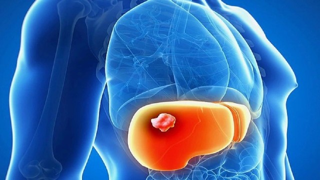 bai-viet/nhung-trieu-chung-va-nguyen-nhan-gay-u-gan-ac-tinh-1.html