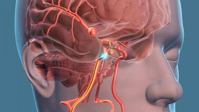 bai-viet/vo-tui-phinh-mach-mau-nao-trieu-chung-nguy-co-va-phuong-phap-chan-doan.html