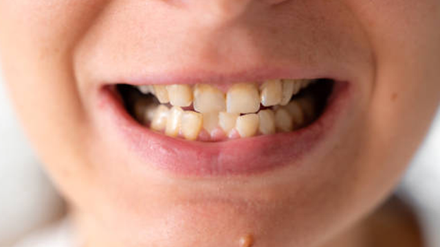 bai-viet/nieng-rang-khap-khenh-bao-nhieu-tien-va-nhung-dieu-can-biet-truoc-khi-nieng.html