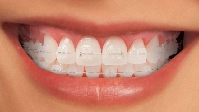 bai-viet/nieng-rang-mac-cai-su-day-trong-co-tot-khong-cach-cham-soc-rang-mieng-sau-khi-nieng-rang.html