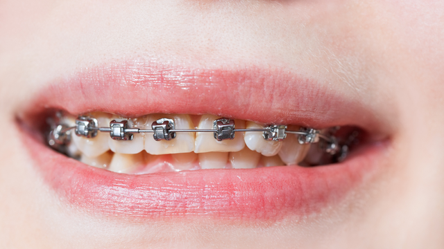 bai-viet/nieng-rang-thua-1-ham-gia-bao-nhieu-nhung-luu-y-can-biet-truoc-khi-nieng-rang.html