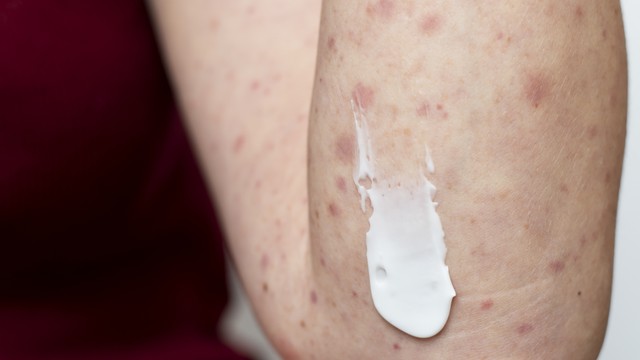 bai-viet/noi-cham-do-tren-da-nguyen-nhan-va-cach-xu-ly.html