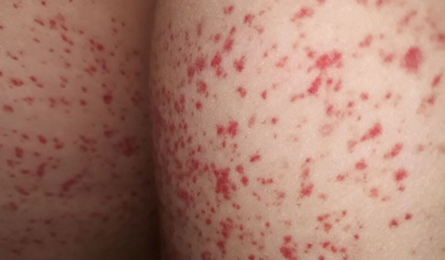 bai-viet/noi-man-do-o-mong-nhung-khong-ngua-la-bi-benh-gi.html