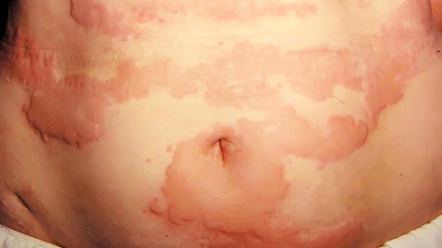 bai-viet/noi-me-day-quanh-bung-nguyen-nhan-dau-hieu-va-cach-dieu-tri-tri-54779.html