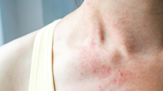 bai-viet/noi-me-day-quanh-co-nguyen-nhan-trieu-chung-va-cach-chua-tri-54778.html