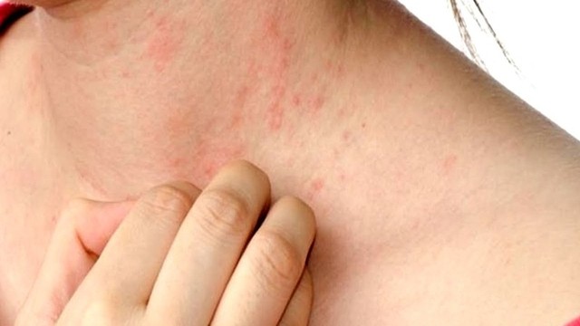 bai-viet/noi-me-day-uong-thuoc-gi-de-het-ngua-ngay-kho-chiu-54381.html