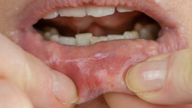 bai-viet/noi-mun-nuoc-trong-mieng-la-gi-cach-khac-phuc-ra-sao-67910.html