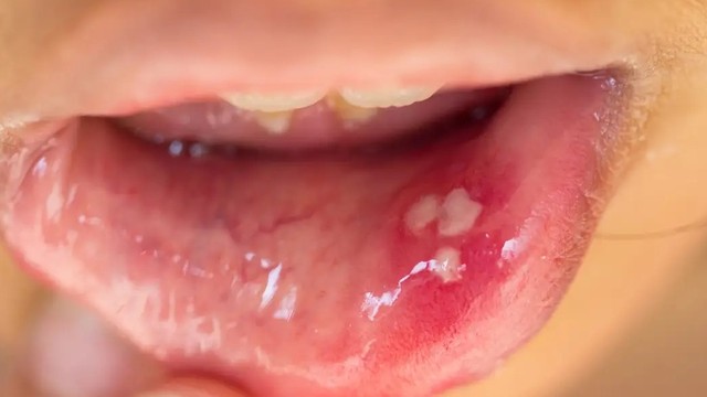 bai-viet/noi-mun-trang-trong-mieng-khong-dau-la-dau-hieu-benh-gi.html