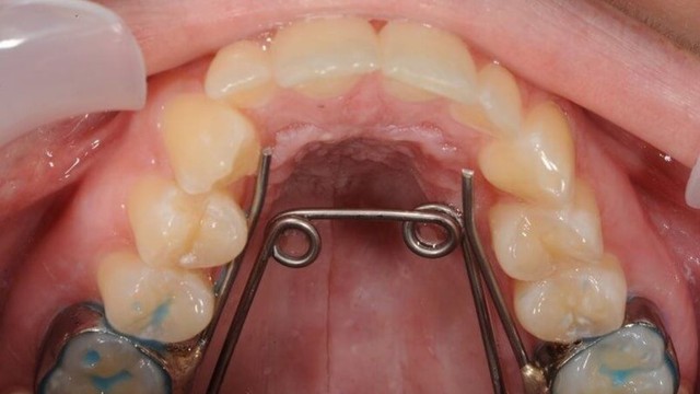 bai-viet/nong-ham-la-gi-khi-nao-can-thuc-hien.html