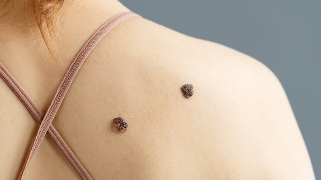 bai-viet/not-ruoi-ac-tinh-la-gi-cach-nhan-biet-not-ruoi-ac-tinh.html