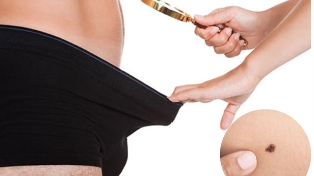 bai-viet/not-ruoi-o-duong-vat-la-dau-hieu-cua-benh-gi-64606.html