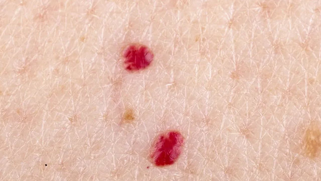 bai-viet/not-ruoi-son-o-co-dan-ong-mang-y-nghia-gi-trong-y-hoc.html