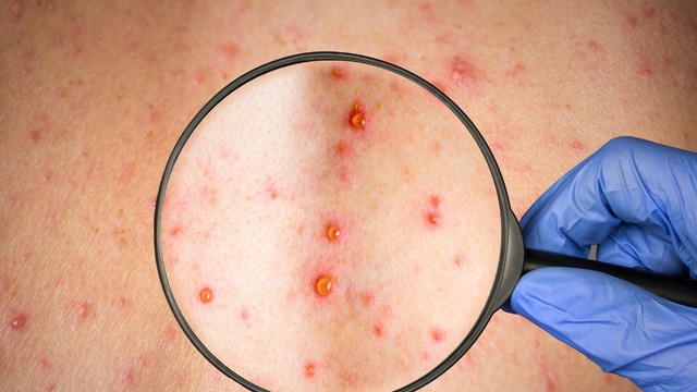 bai-viet/not-thuy-dau-co-mu-phai-lam-sao-cach-phong-benh-thuy-dau-hieu-qua.html