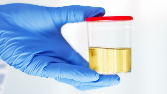 bai-viet/nuoc-tieu-co-vi-khuan-khong-nguyen-nhan-khien-nuoc-tieu-co-vi-khuan-va-cach-phong-ngua-hieu-qua.html