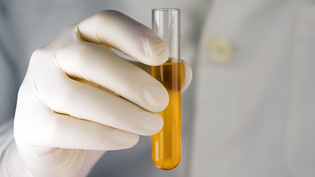 bai-viet/nuoc-tieu-mau-cam-bi-benh-gi-60635.html