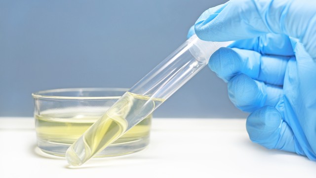 bai-viet/nuoc-tieu-mau-gi-la-tot-mau-sac-nuoc-tieu-phan-anh-tinh-trang-suc-khoe-nhu-the-nao.html