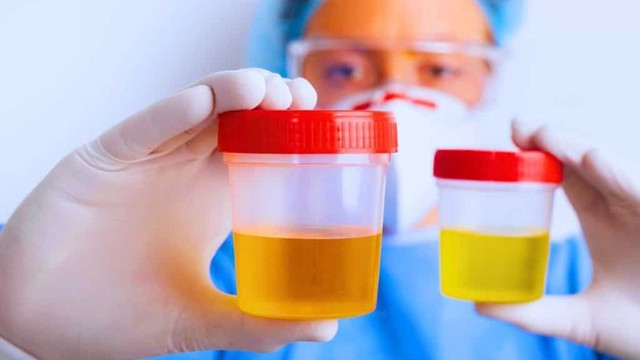 bai-viet/nuoc-tieu-mau-vang-dam-o-nu-co-sao-khong.html