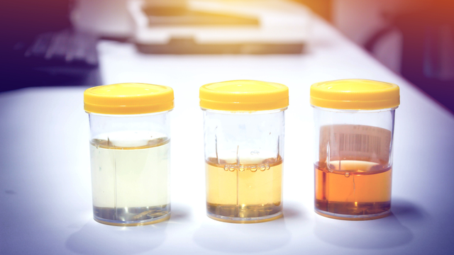 bai-viet/sang-ngu-day-thay-nuoc-tieu-vang-nhu-nuoc-che-co-lam-sao-khong.html