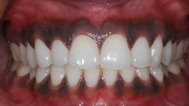 bai-viet/nuou-rang-bi-den-nguyen-nhan-trieu-chung-va-cach-dieu-tri.html