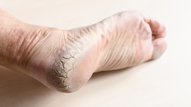 benh/nut-got-chan-1381.html