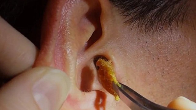 bai-viet/nut-ray-tai-co-tac-hai-gi-cach-xu-ly-va-phong-ngua-ra-sao.html