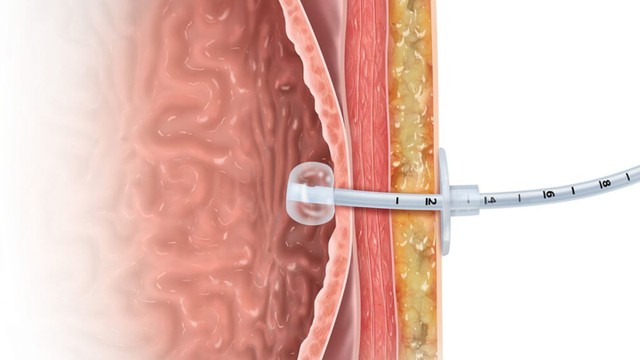 bai-viet/tim-hieu-chi-tiet-ve-thu-thuat-dat-ong-thong-da-day.html