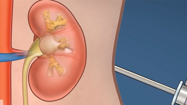 bai-viet/pcnl-la-gi-nhung-loi-ich-khi-ung-dung-pcnl.html