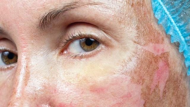 bai-viet/peel-da-hoa-hoc-uu-nhuoc-diem-va-3-cap-do-peel-da.html