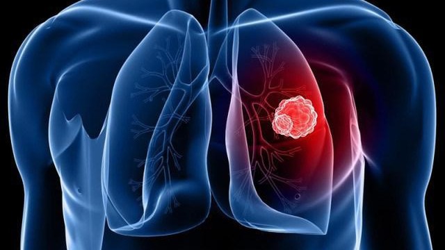 bai-viet/phac-do-dieu-tri-ap-xe-phoi-bo-y-te-va-cach-cham-soc-sau-dieu-tri.html