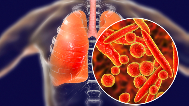 bai-viet/phac-do-dieu-tri-lao-cua-bo-y-te-moi-nhat-hien-nay.html